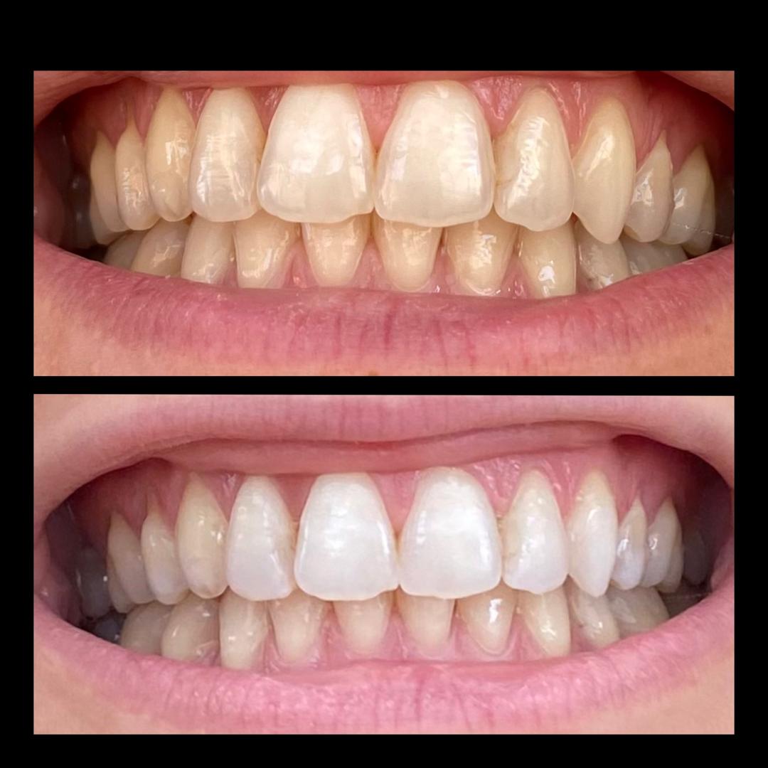 Vue du sourire de face — avant