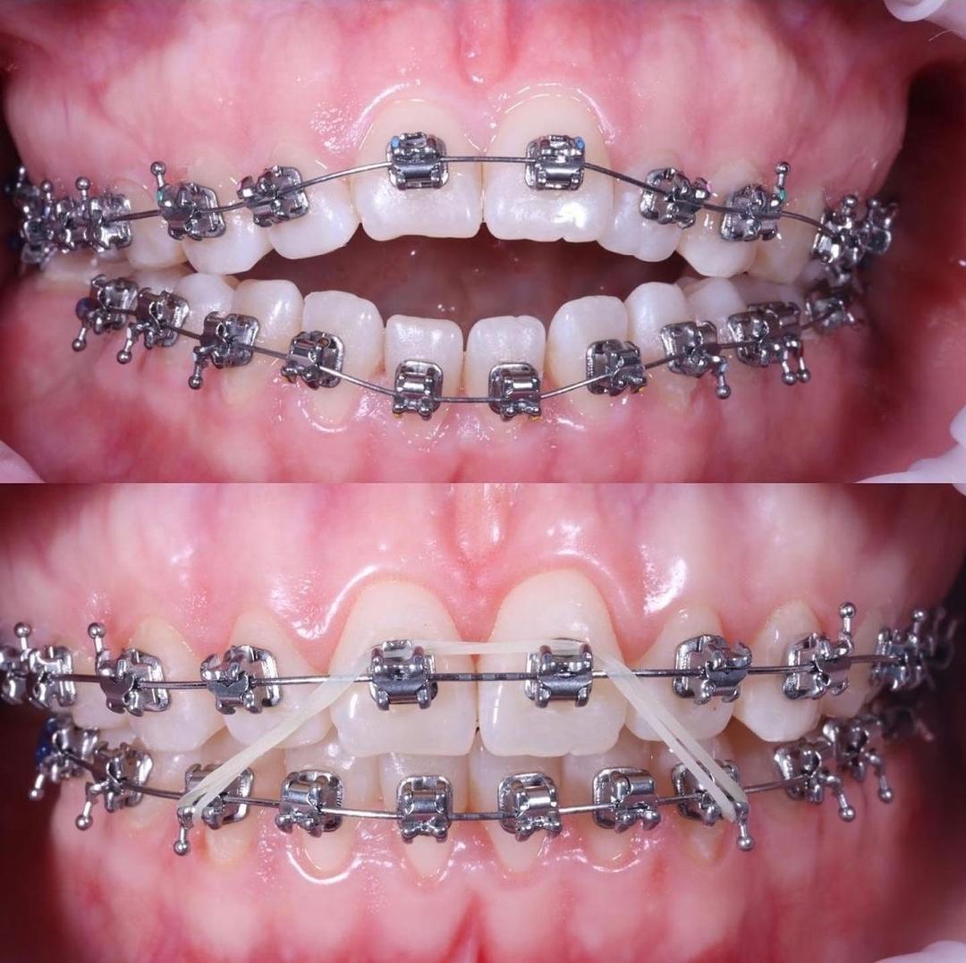 Vue de face des dents avec un appareil orthodontique — au début du suivi