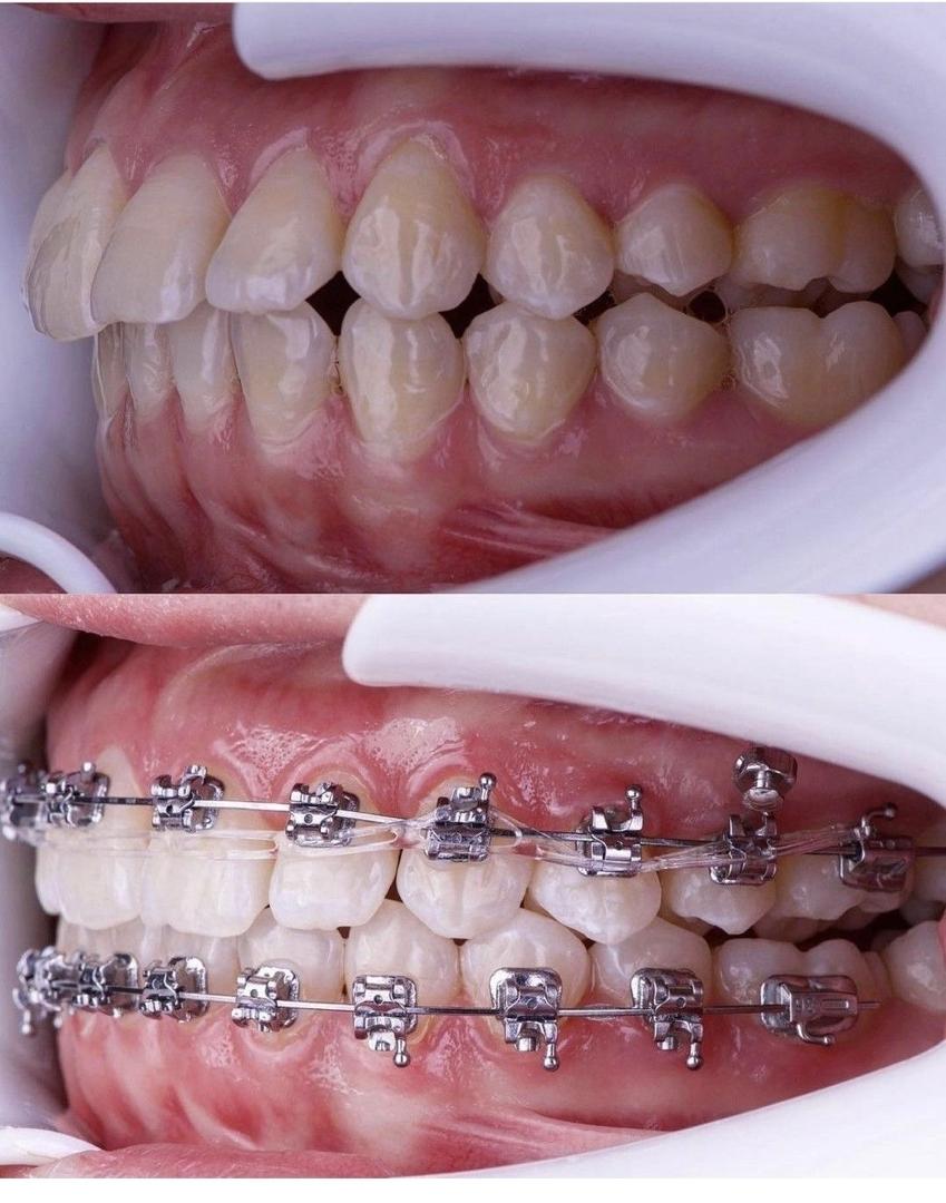 Vue latérale des dents — avant